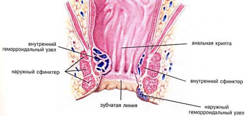 Геморрой у мужчин - как проявляется, первые признаки, симптомы внутреннего геморроя