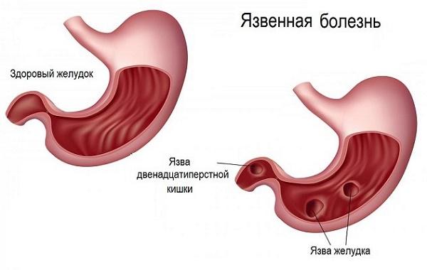 Признаки язвенной болезни